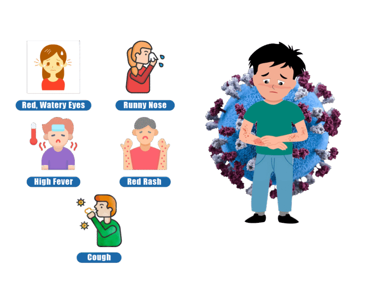 Measles Outbreak in Texas 2025: What You Must Know